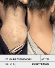 Touché Duo Anti Imperfection - Touché Skincare Lab