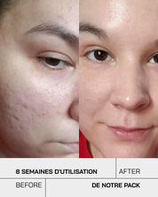 Touché Duo Anti Imperfection - Touché Skincare Lab