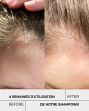 Shampoing Anti-Psoriasis