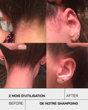 Shampoing Anti-Psoriasis