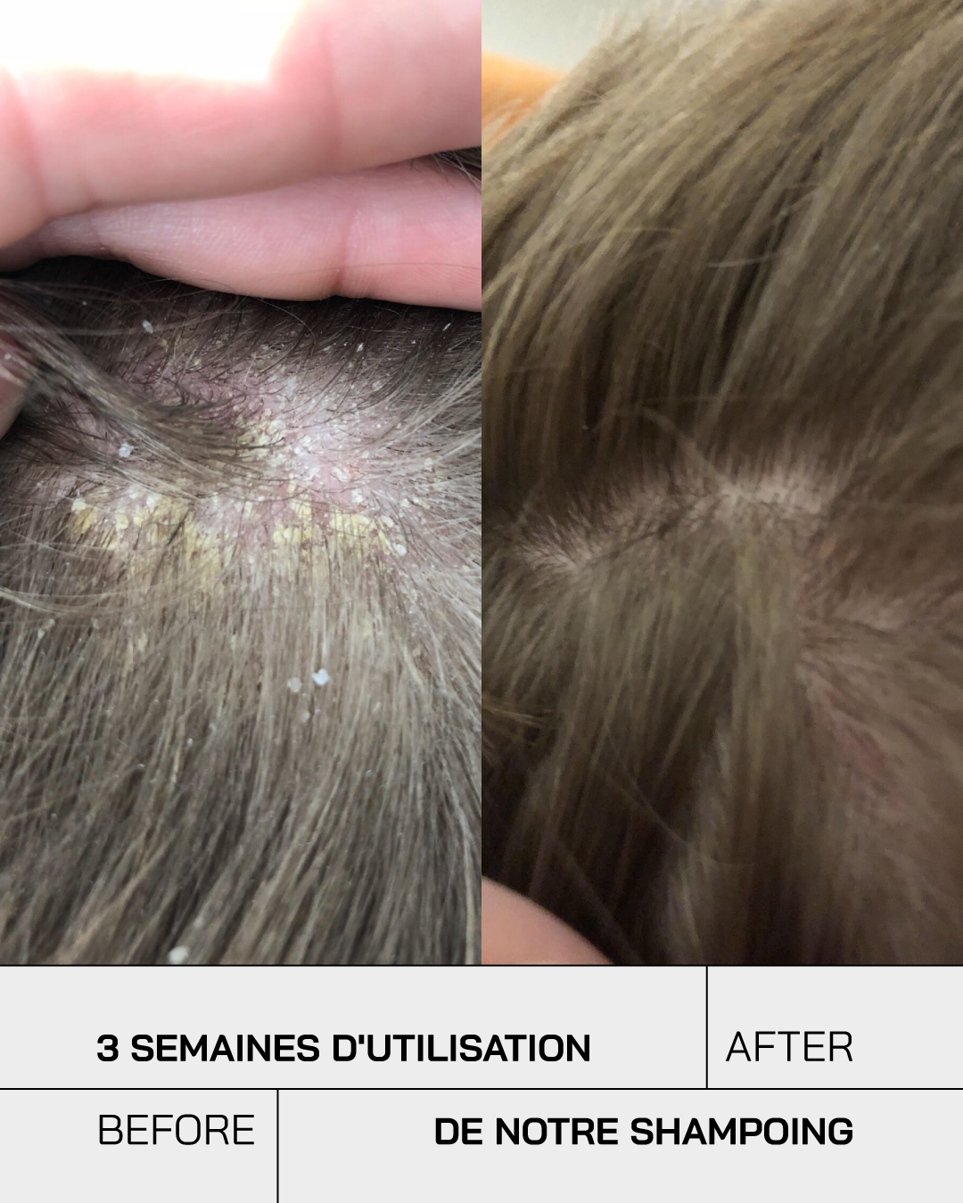 Shampoing Anti-Psoriasis